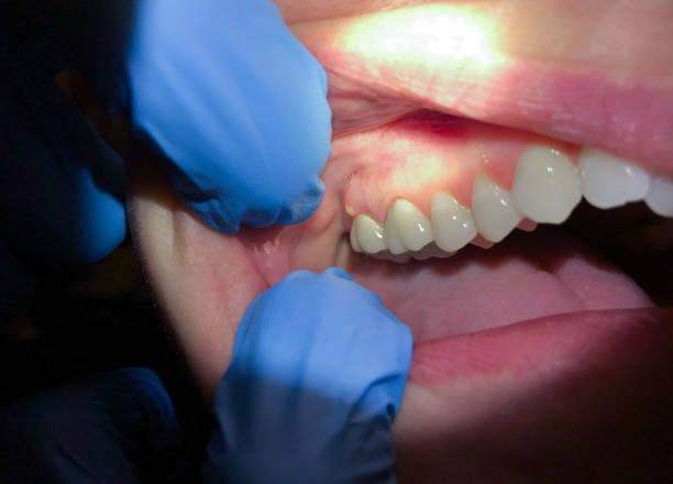 Best Knocked-Out Tooth (Avulsed Tooth) Treatment in Girard, KS